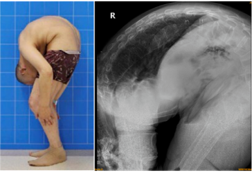 求医28年的"折叠人"出院,最让我感动的却是他的母亲