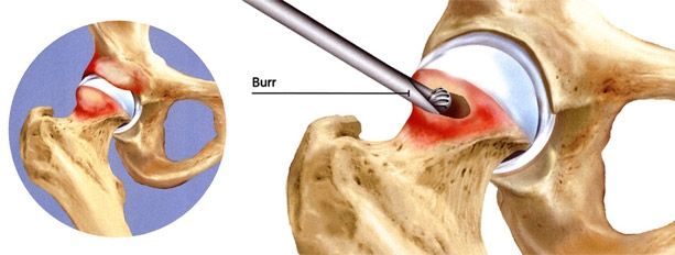 髋关节撞击hip impingement