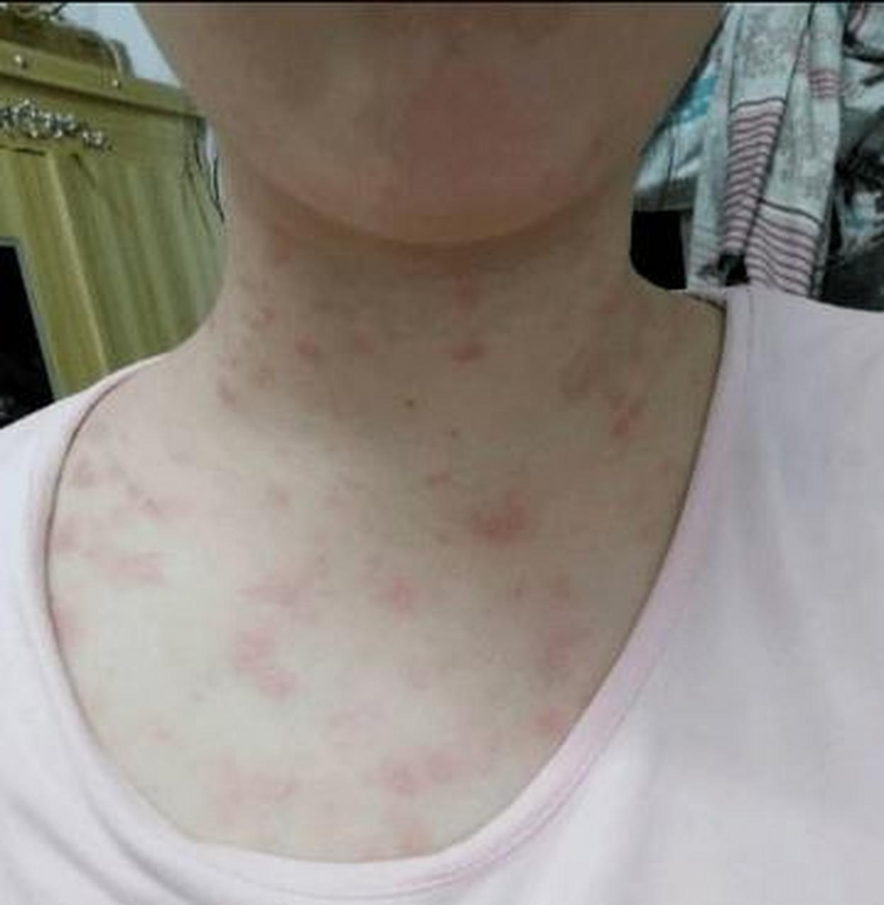 玫瑰糠疹的治疗原则:减轻症状,缩短病程  1,一般治疗:在急性期忌热水