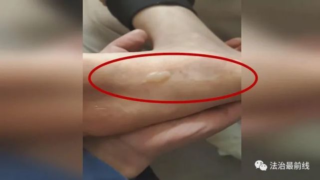 孩子被电热毯烫伤!厂家这么说