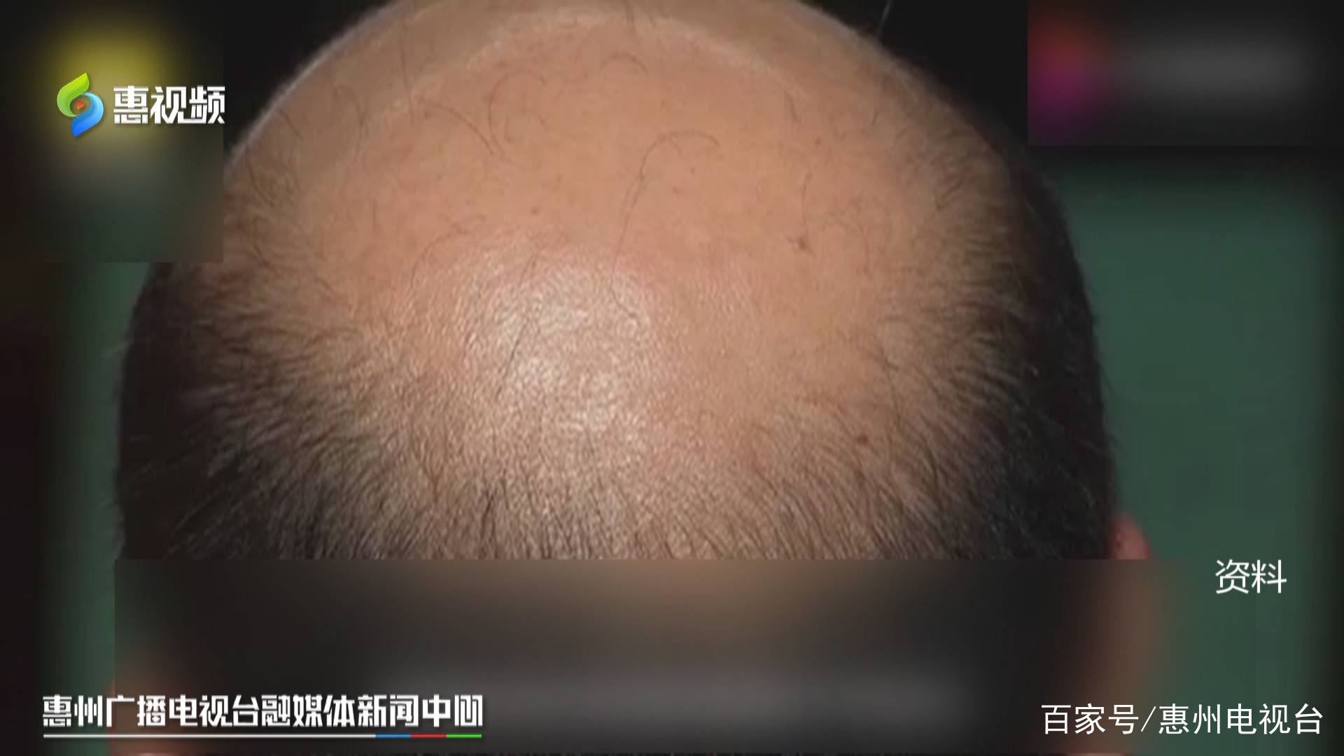 脱发植发群(植发微信交流群)