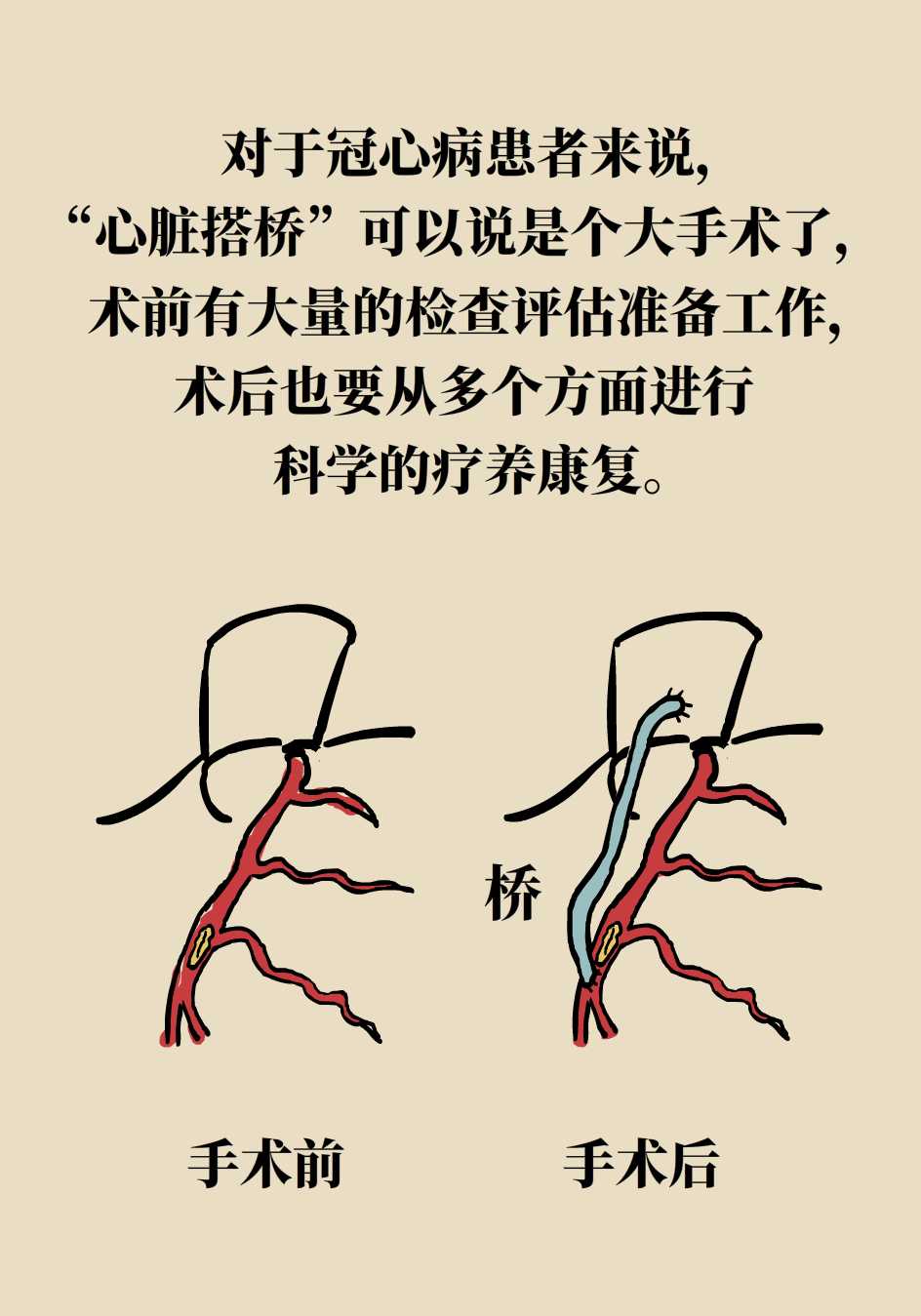 "心脏搭桥"后不能老是静养"护桥"后还要靠运动手术之后拔掉氧气管