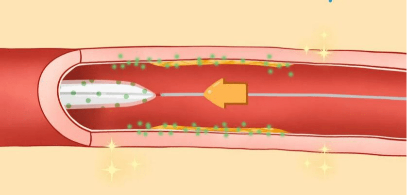 好消息!"千元级"药物球囊正式落地彭医!