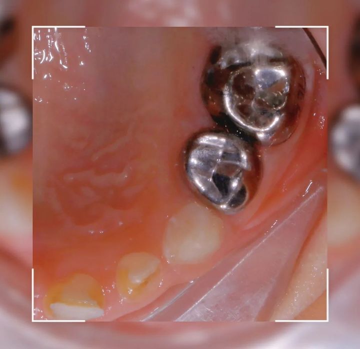 补救宝贝龋齿的利器——"预成冠"