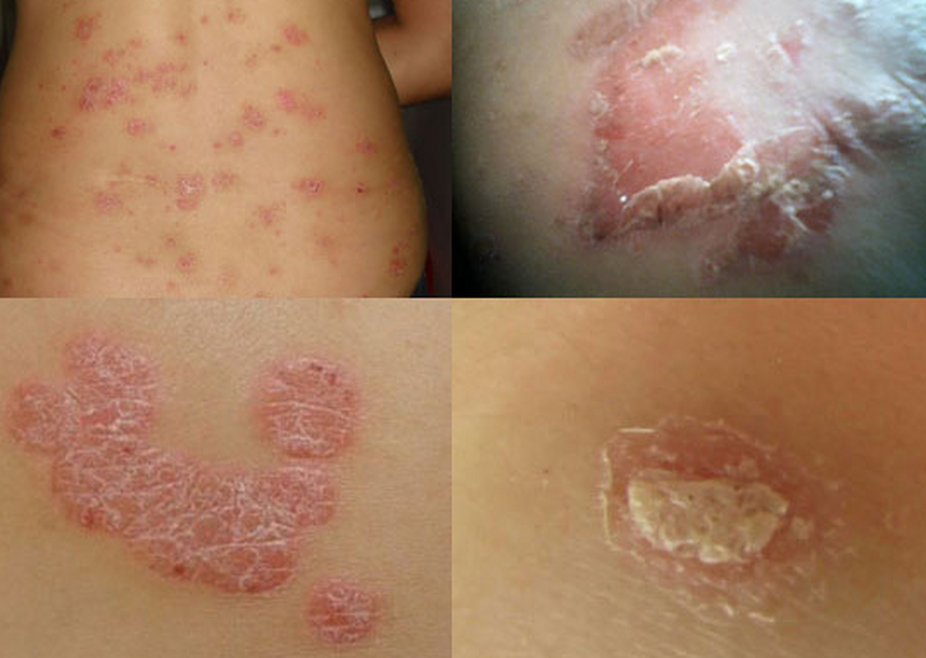 银屑病靠运动和保持好心情会自愈吗?