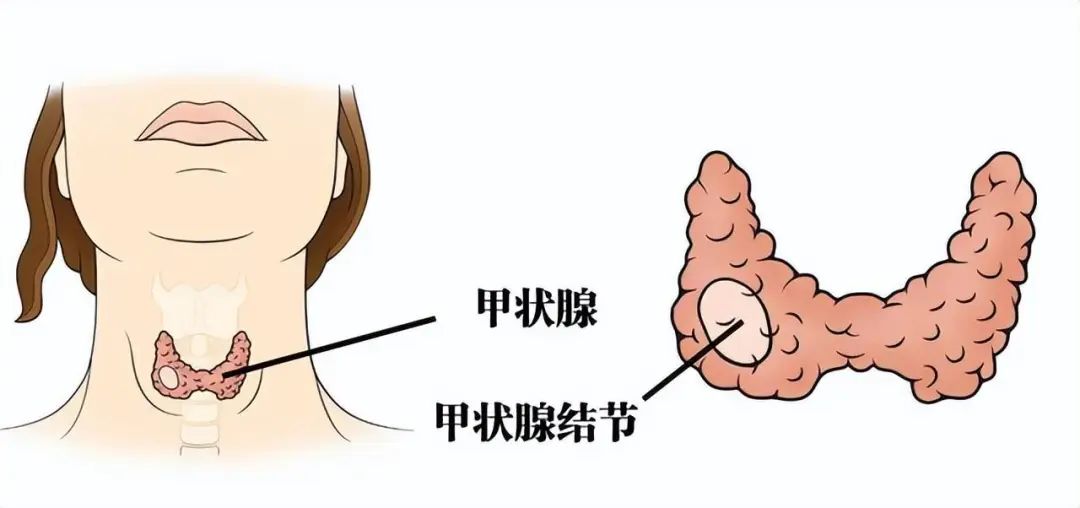 甲状腺结节,乳腺增生该怎么办?一味药方教你如何预防,调理