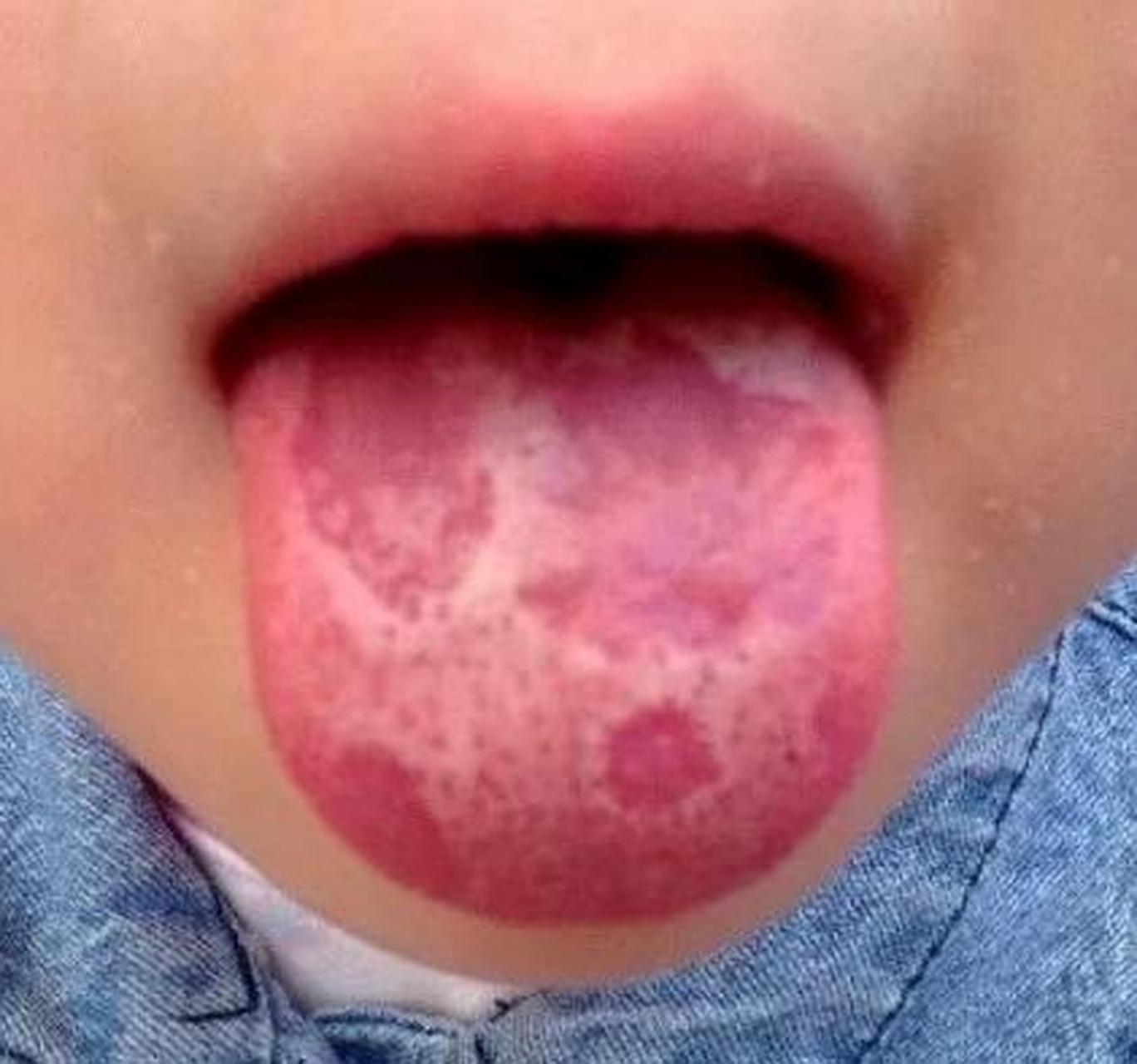 应网友留言要求,来说说地图舌 地图舌,跟它的名字一样,舌苔看起来一块