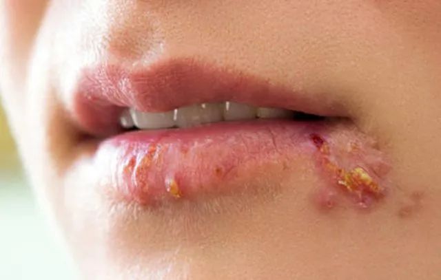 嘴角长泡可不是"上火",而是病毒感染,还会互相传染