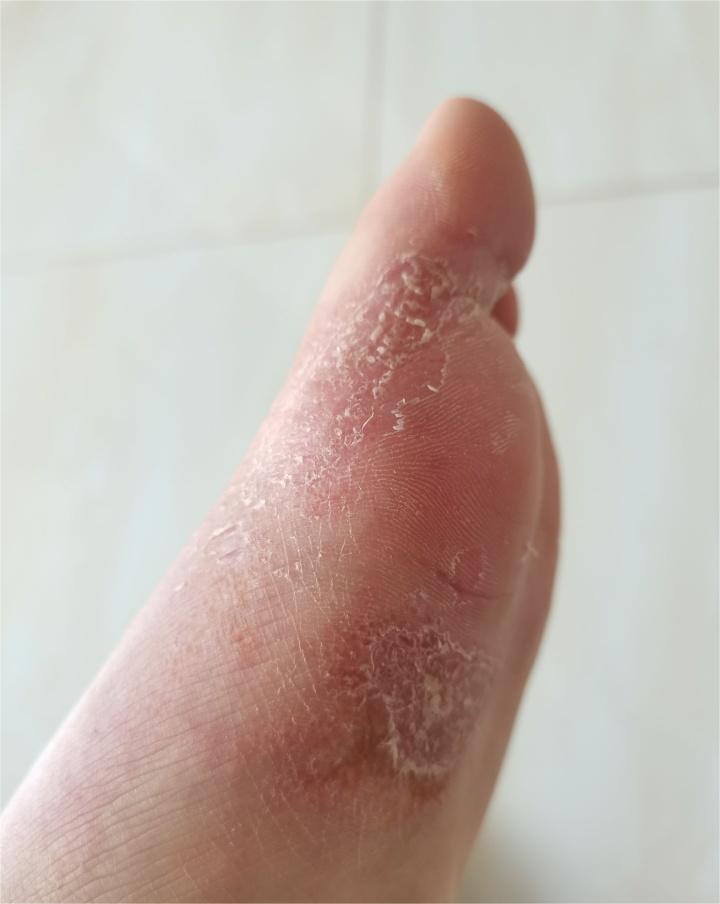水泡型脚气如何除根?过来人经验分享!居家就能摆脱脚气困扰!