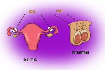 男性结扎和女性结扎