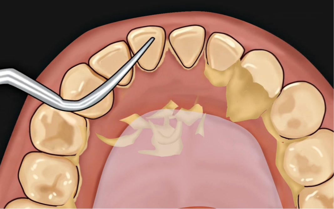牙缝里的牙结石,怎么有效清除?医生:教你3个方法,轻松除牙垢