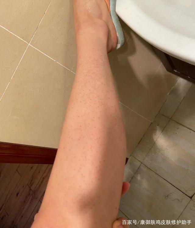 鸡皮肤的心酸路(鸡皮肤永远治不好了) 鸡皮肤的心酸路(鸡皮肤永远治不好了)