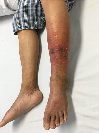 台风天千万别穿这种鞋趟水!或惹上败血病!珠海已有人中招