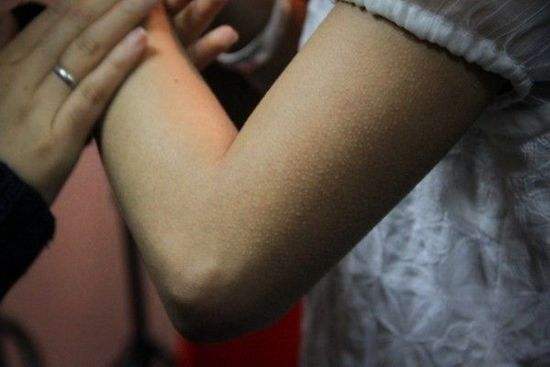 手臂上暗斑鸡皮肤(手臂鸡皮肤越来越严重怎么办)