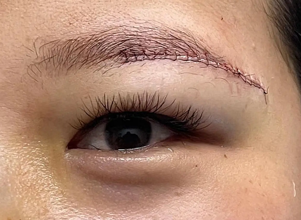 提眉后效果好不好?盘点提眉手术带来的优点和缺点