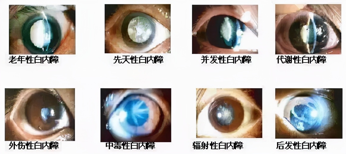 先天疾病—白内障,发病主要症状会引起斜视,三分之一病例因遗传