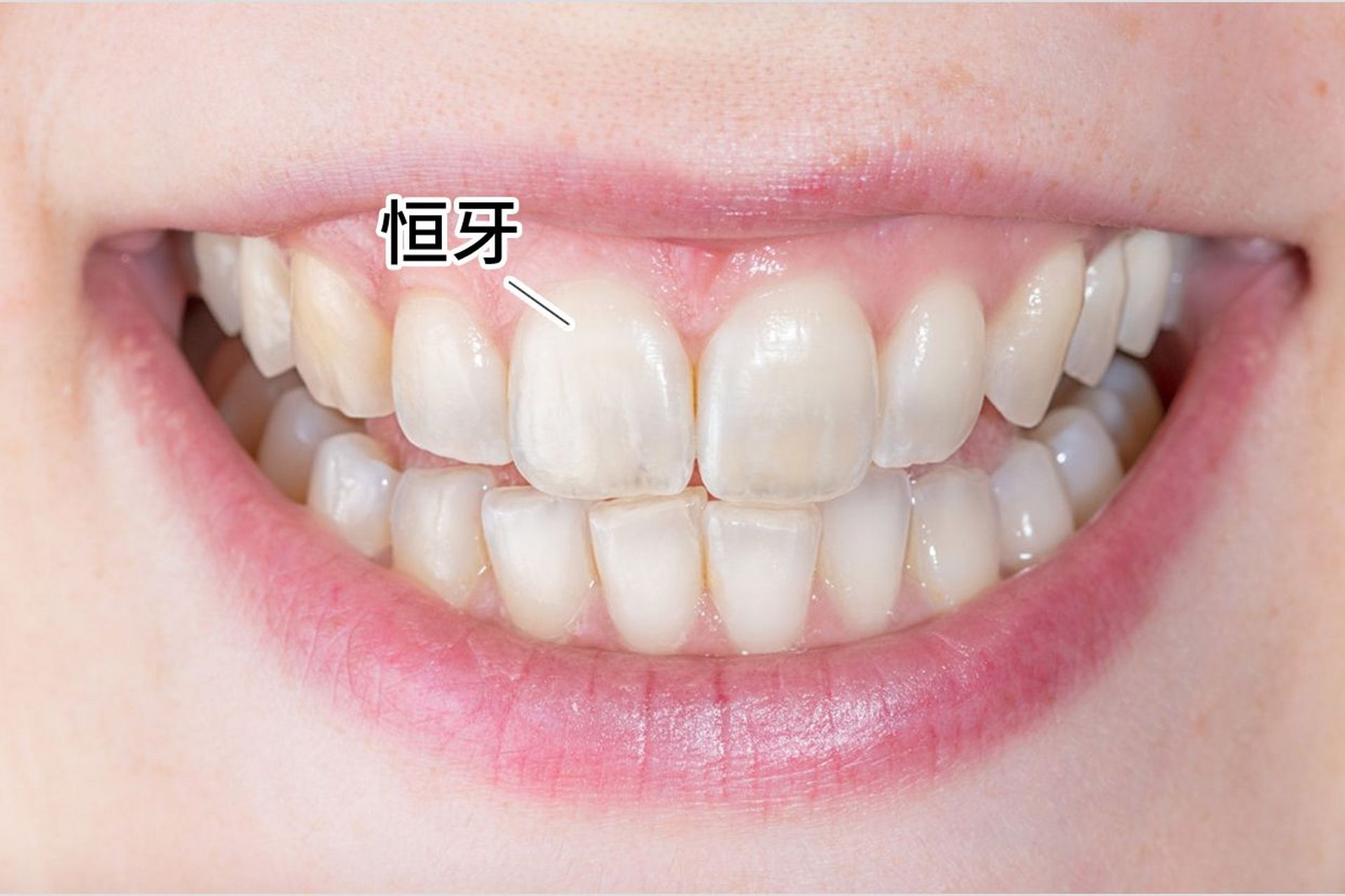 宝宝乳牙掉了但恒牙还没长怎么处理?