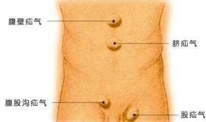成人脐疝,是一种后天性疝,由腹壁薄弱及腹内压力过大所致