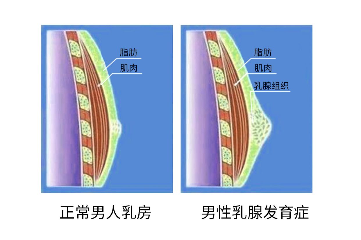 男性乳腺增生图片样子图片