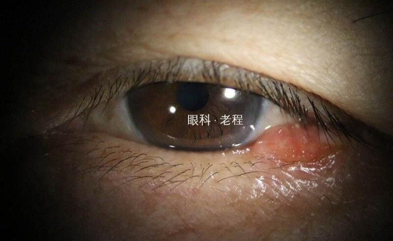 睑板腺癌是眼睑特有的恶性肿瘤,首选治疗方法是手术治疗