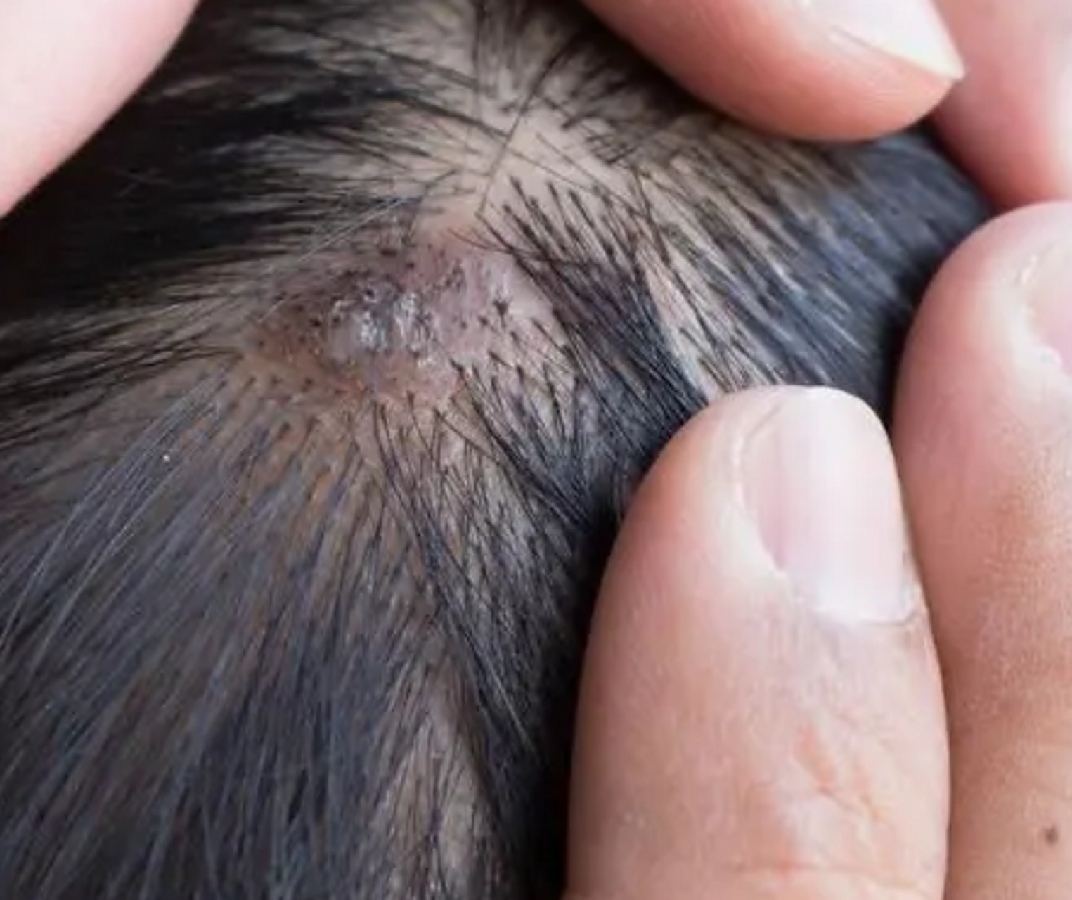 40岁的张先生早上起来,闻到妻子头上臭臭的,就帮妻子