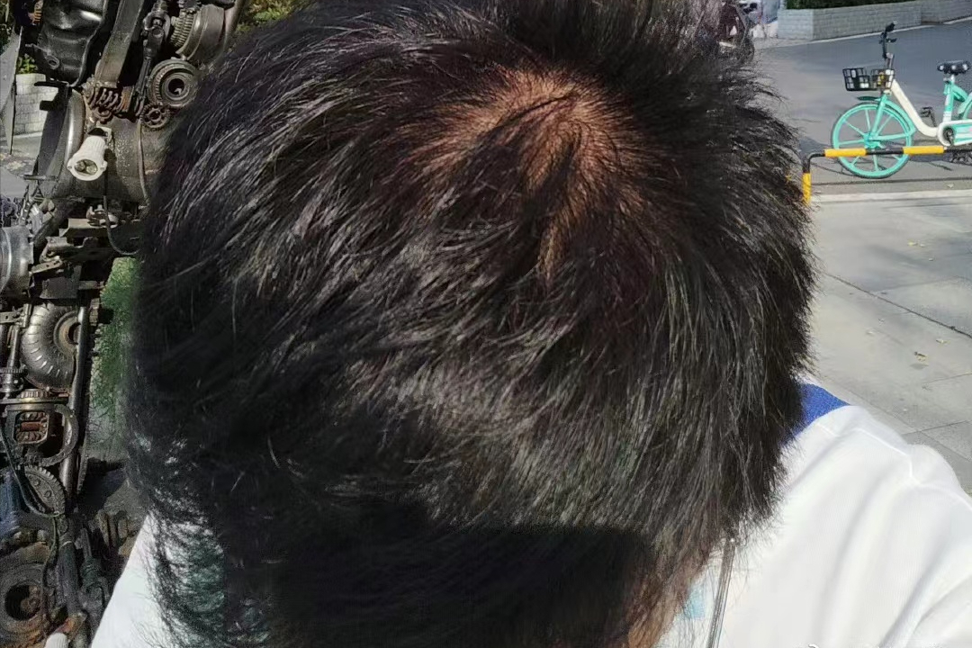 男生使用5%米诺地尔,三个月头发居然长了这么多?