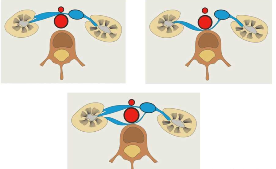 胡桃夹食管,会出现胸痛及吞咽困难,应及时治疗,一般不会遗传