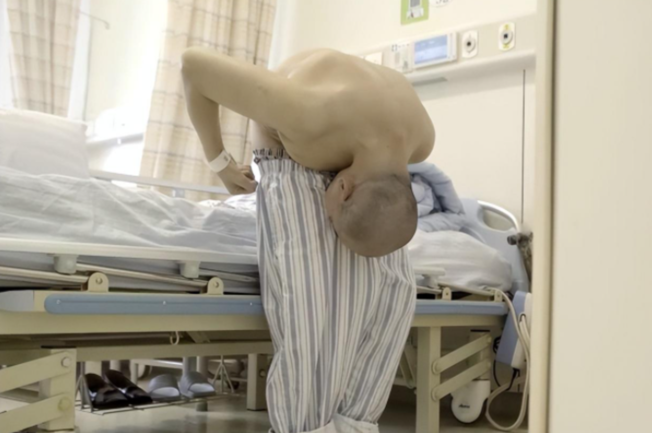 回顾"折叠人"李华:嘴巴离大腿只有两厘米,被敲断4处骨头后获重生