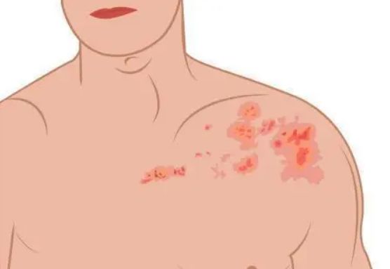 胸前起小水泡很小像汗珠挤就破了