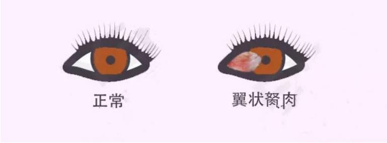 眼角长的那块"肉",到底该不该做手术?