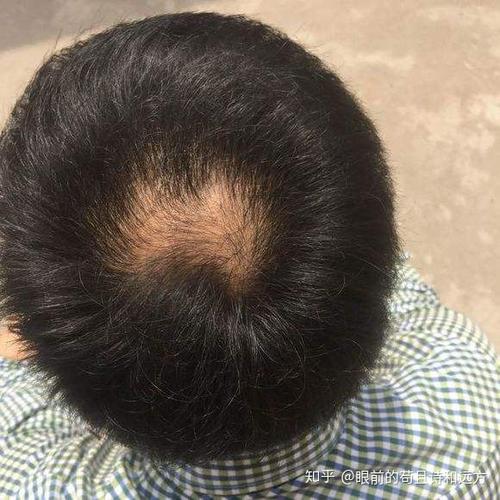 "一个旋"和"两个旋"的孩子有什么区别呢?哪种更健康?