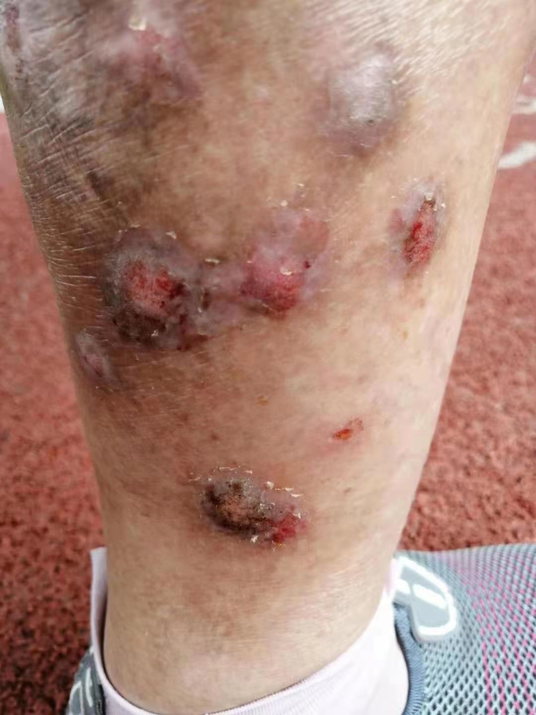 箹诗工坊:小腿皮肤几十年来又痒又破