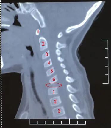 颈椎ct:红圈所在位置为琦琦(化名)缺失的颈7椎体