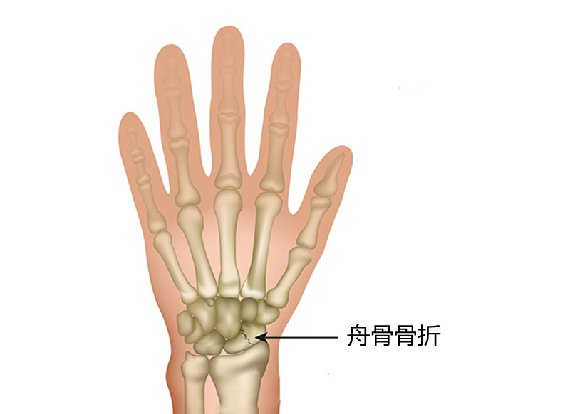 手舟状骨骨折手术步骤图片