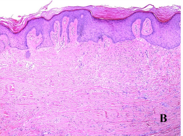 头颈部病理十大-促纤维增生性恶性黑色素瘤十大鉴别(二)