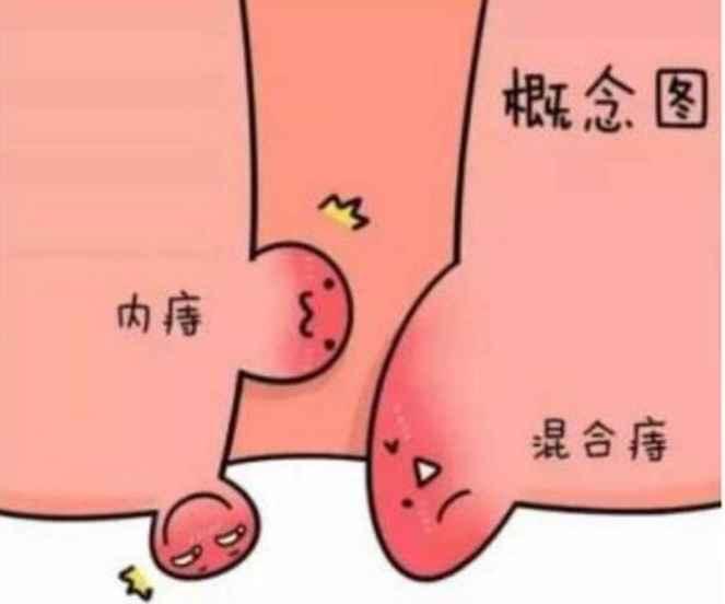 女性痔疮外痔 初期图片