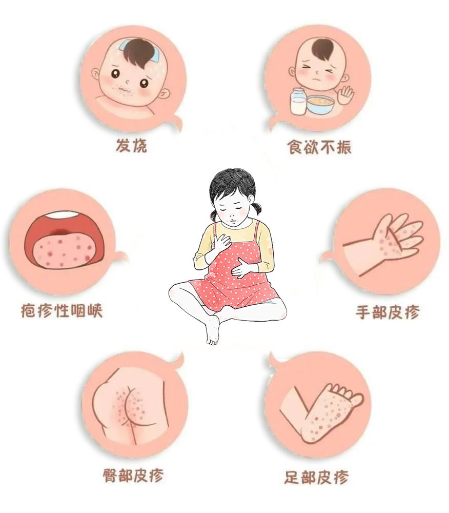 肠道病毒cox a16型手足口病,具有传染性,近年来有增多趋势