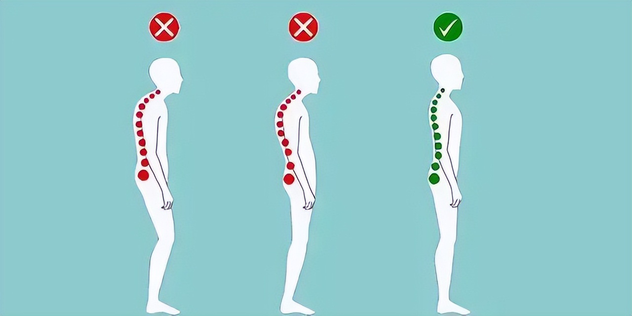 脊柱侧弯和驼背区别图图片