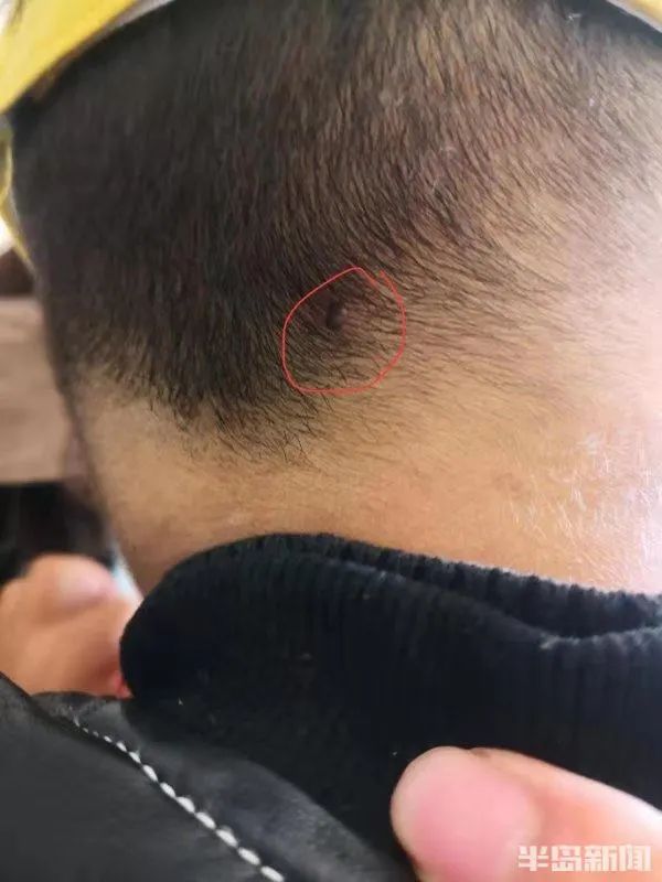 青岛3岁男童后脑勺疼,罪魁祸首又是这个"黑点"!严重可致命.