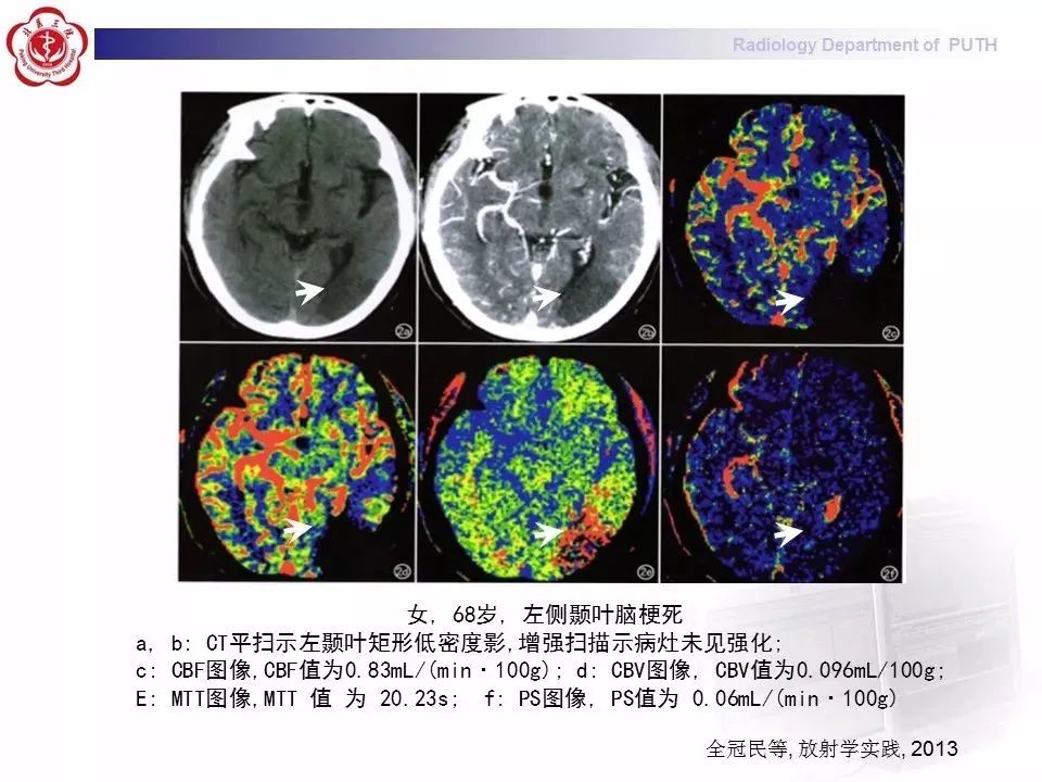 ct灌注成像图像解读图片