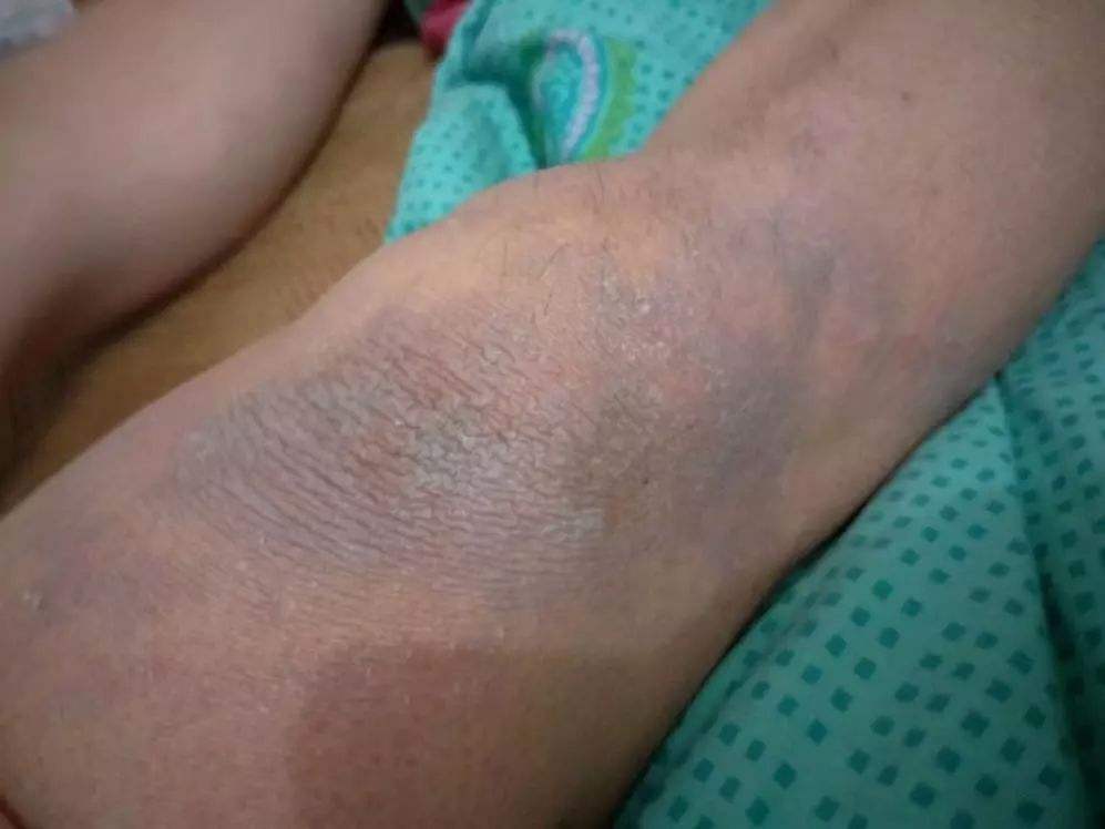 黑棘皮病会出现在身体各个部位,身体出现问题时应及时检查