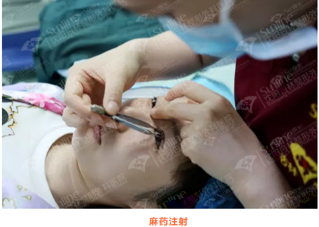 沈阳杏林整形外科医院割双眼皮效果