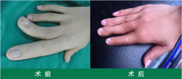 顺德和平外科医院手显微外科专家吴祥主任:巨指症如何治?