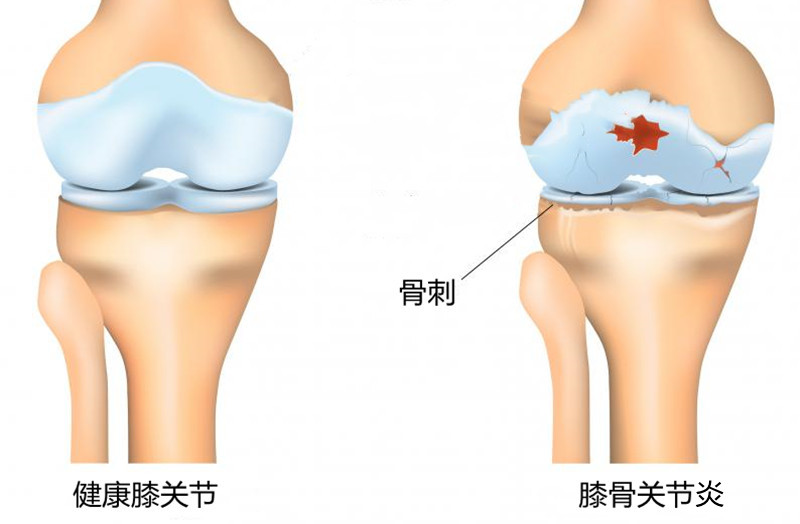 骨刺长在哪里图片图片