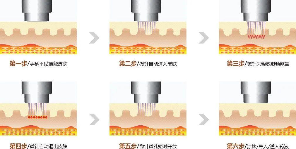 昆明黄金针雕费用 云南铜雀台美容医院金岚教授