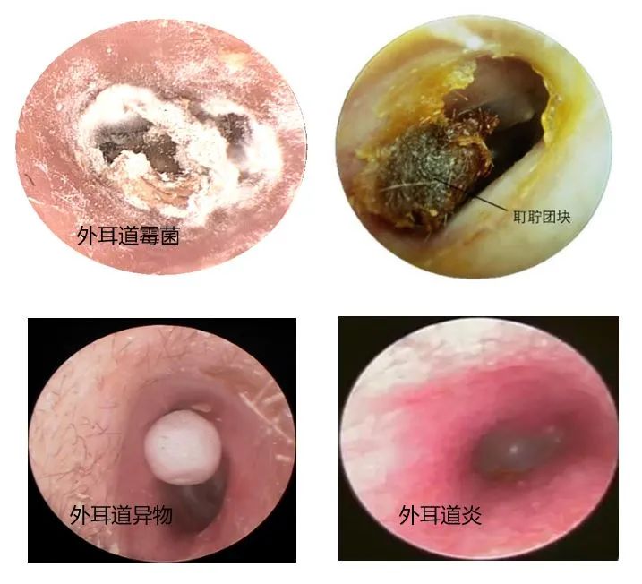 造成耳道痒的常见原因有:外耳道耵聍,外耳道霉菌,外耳道湿疹,细菌性外