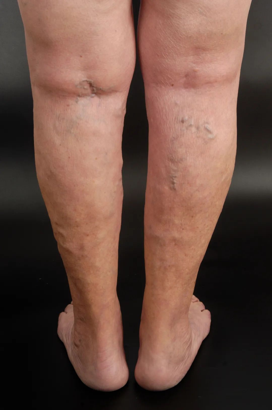 别划走!关于静脉曲张这8个防治方法,你确定都知道?