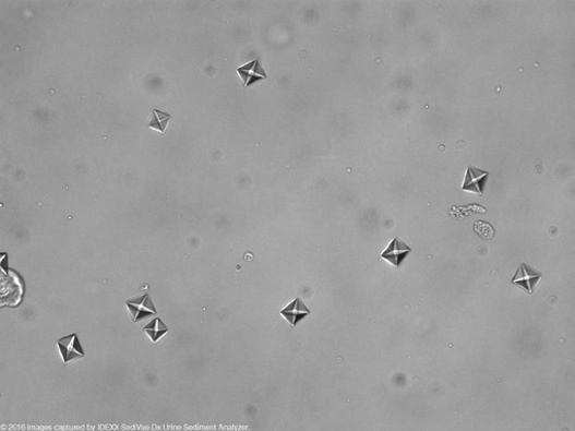 尿检图谱大合集:16张图片手把手教你辨认尿液中的草酸钙结晶