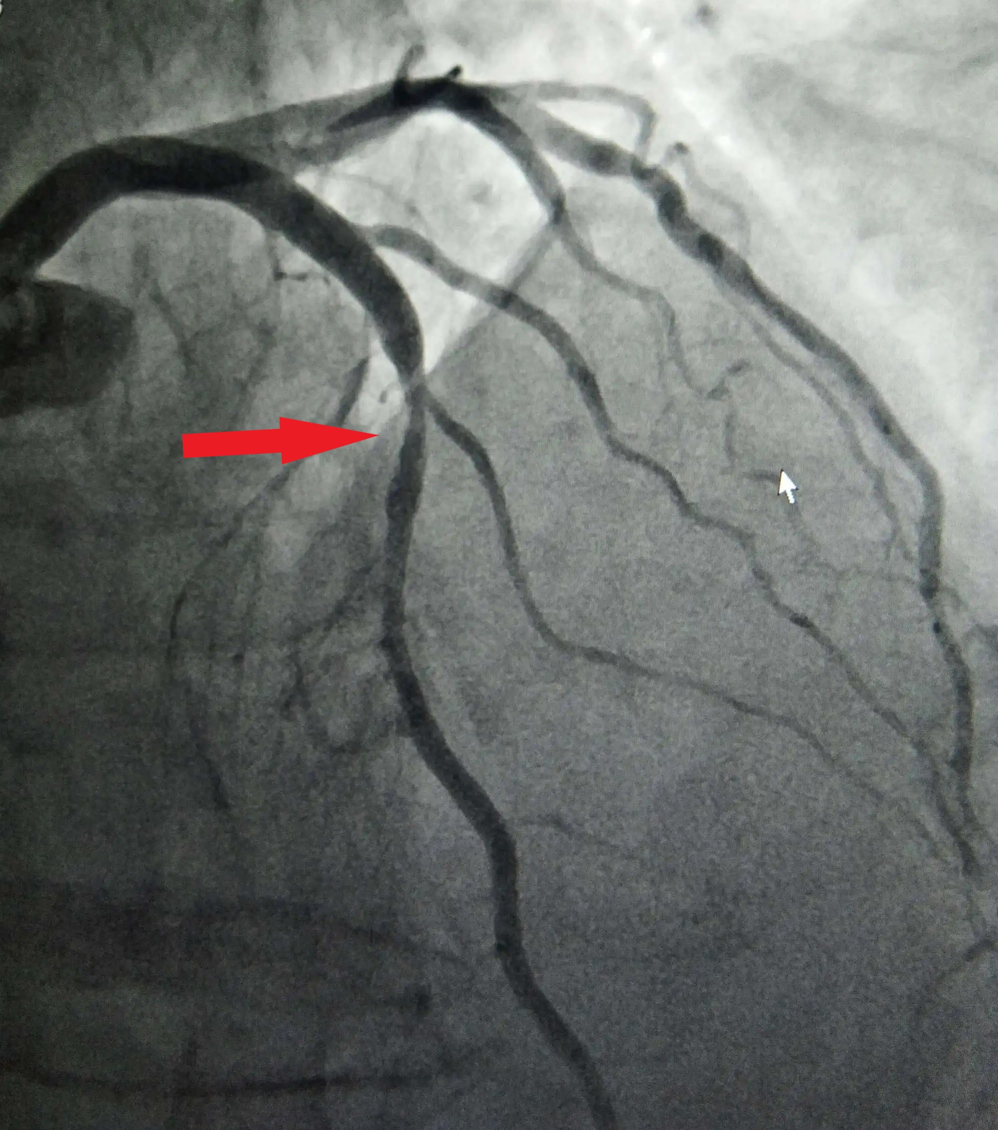 50岁男子做心脏造影刚2年突发心梗!医生:哪些人心血管更容易堵