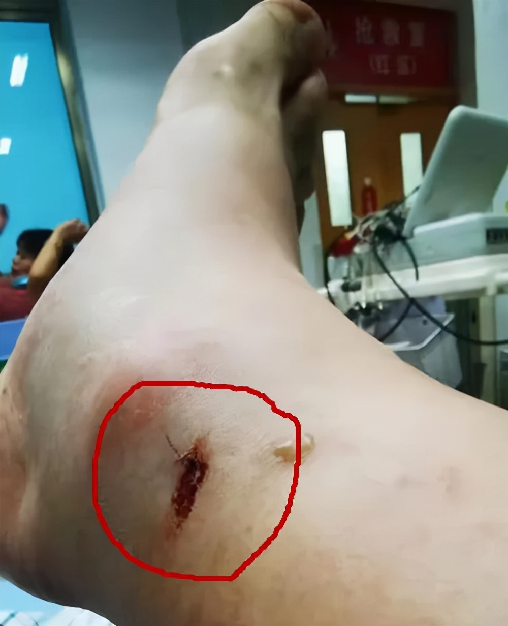 打死,仅48毫克毒液就可致命!浙江男子被原矛头蝮咬伤,直呼命大